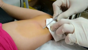 Río Negro invierte más de 1 millones para garantizar implantes anticonceptivos gratuitos en el sistema público