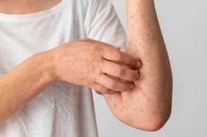 Sarampión: cuáles son los síntomas, cómo prevenirlo y quiénes deben vacunarse